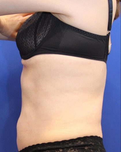 CoolSculpting Elite Before & After Patient #14208