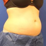 CoolSculpting Elite Before & After Patient #14209