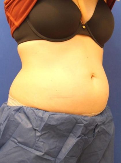 CoolSculpting Elite Before & After Patient #14209