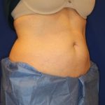 CoolSculpting Elite Before & After Patient #14209