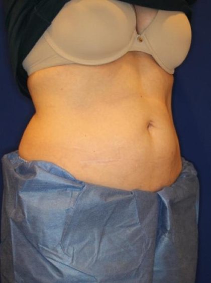 CoolSculpting Elite Before & After Patient #14209