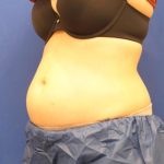 CoolSculpting Elite Before & After Patient #14209
