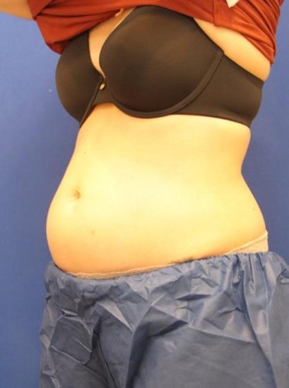 CoolSculpting Elite Before & After Patient #14209