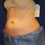 CoolSculpting Elite Before & After Patient #14209