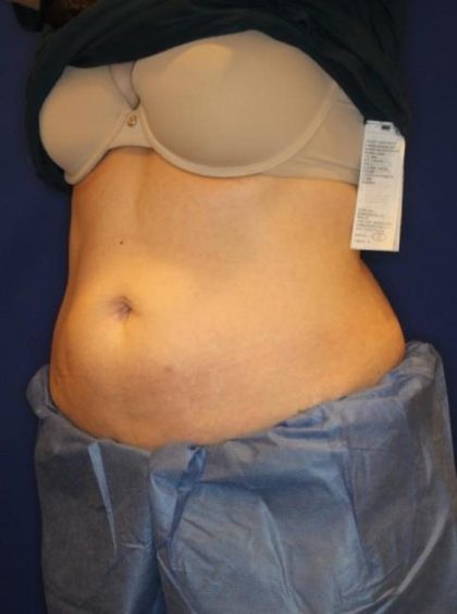 CoolSculpting Elite Before & After Patient #14209