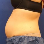 CoolSculpting Elite Before & After Patient #14209