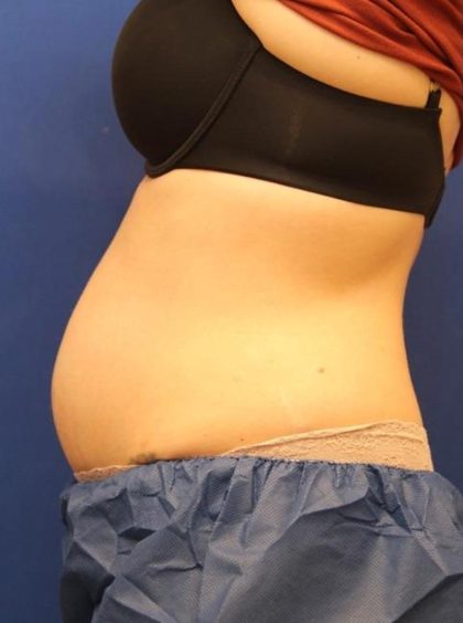 CoolSculpting Elite Before & After Patient #14209