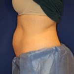 CoolSculpting Elite Before & After Patient #14209