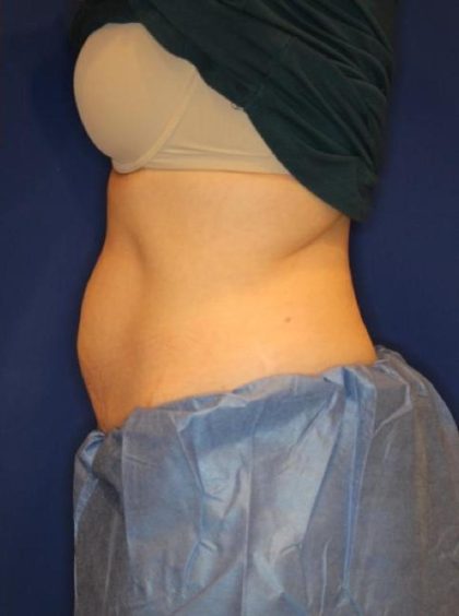 CoolSculpting Elite Before & After Patient #14209