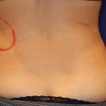 CoolSculpting Elite Before & After Patient #14210