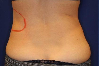 CoolSculpting Elite Before & After Patient #14210