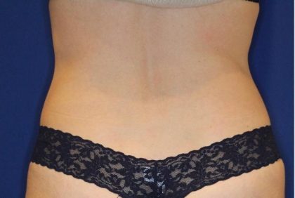 CoolSculpting Elite Before & After Patient #14210