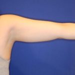CoolSculpting Elite Before & After Patient #14211