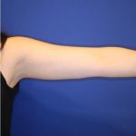 CoolSculpting Elite Before & After Patient #14211