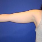 CoolSculpting Elite Before & After Patient #14211