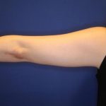 CoolSculpting Elite Before & After Patient #14211