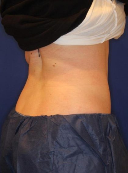 Sculpsure Before & After Patient #14196
