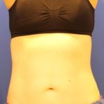 Sculpsure Before & After Patient #14197