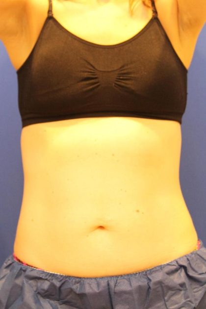 Sculpsure Before & After Patient #14197