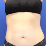 Sculpsure Before & After Patient #14197