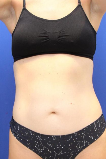 Sculpsure Before & After Patient #14197