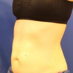 Sculpsure Before & After Patient #14197