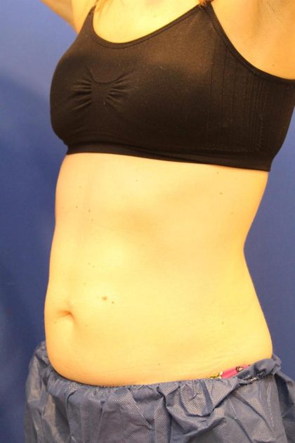 Sculpsure Before & After Patient #14197