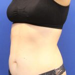 Sculpsure Before & After Patient #14197