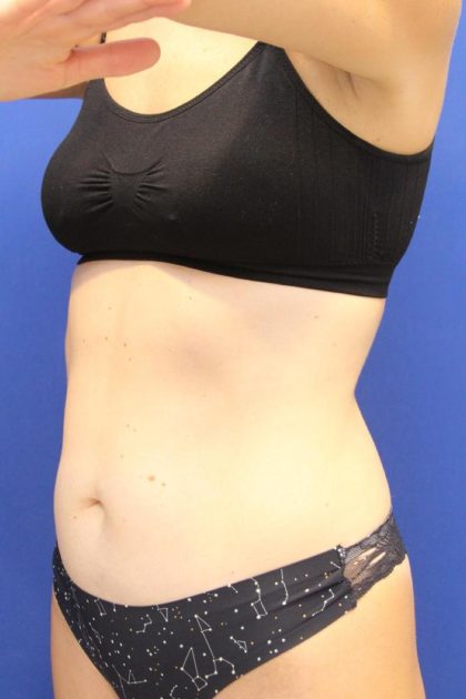 Sculpsure Before & After Patient #14197