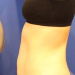Sculpsure Before & After Patient #14197