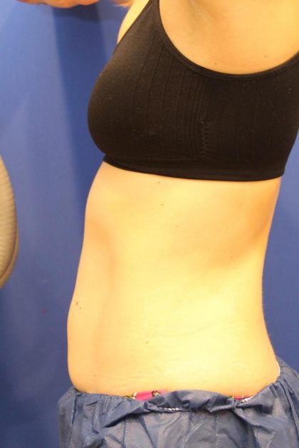 Sculpsure Before & After Patient #14197