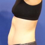 Sculpsure Before & After Patient #14197