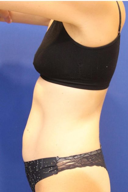 Sculpsure Before & After Patient #14197