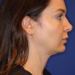 Sculpsure Before & After Patient #14198