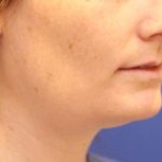 Sculpsure Before & After Patient #14199