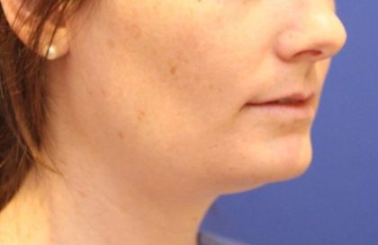 Sculpsure Before & After Patient #14199