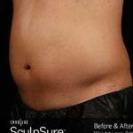 Sculpsure Before & After Patient #14200