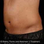 Sculpsure Before & After Patient #14200