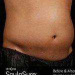 Sculpsure Before & After Patient #14200