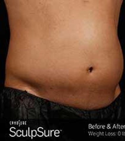 Sculpsure Before & After Patient #14200