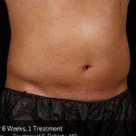 Sculpsure Before & After Patient #14200