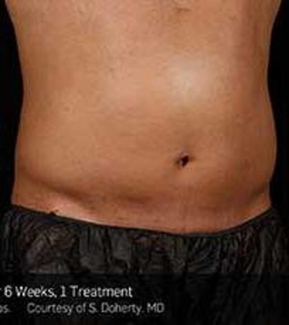 Sculpsure Before & After Patient #14200