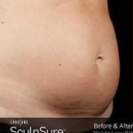 Sculpsure Before & After Patient #14201