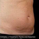 Sculpsure Before & After Patient #14201