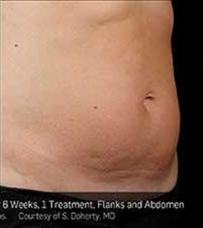 Sculpsure Before & After Patient #14201