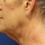 Sculpsure Before & After Patient #14202