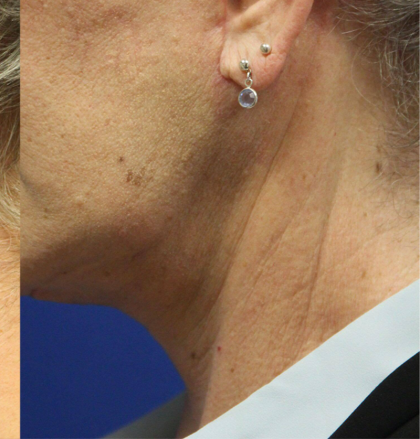 Sculpsure Before & After Patient #14202