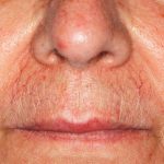 Vascular Lesions Removal Before & After Patient #14192