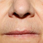 Vascular Lesions Removal Before & After Patient #14192