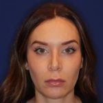 Volux Before & After Patient #13909